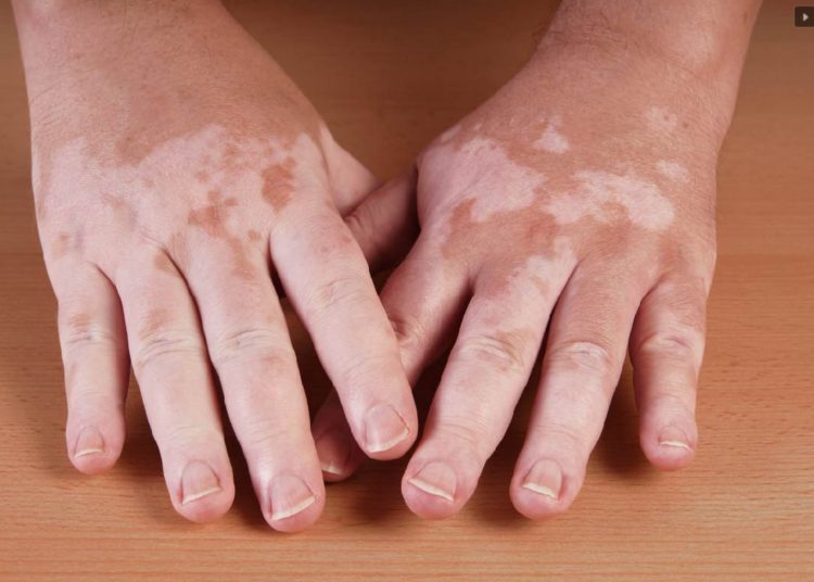 foto de mãos afetadas pelo vitiligo