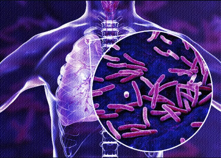 Tuberculose imagem