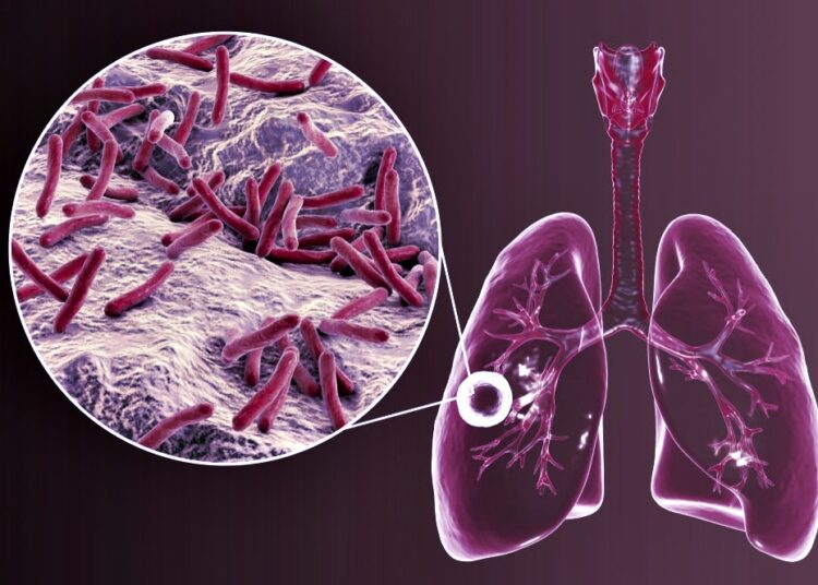 Tuberculose