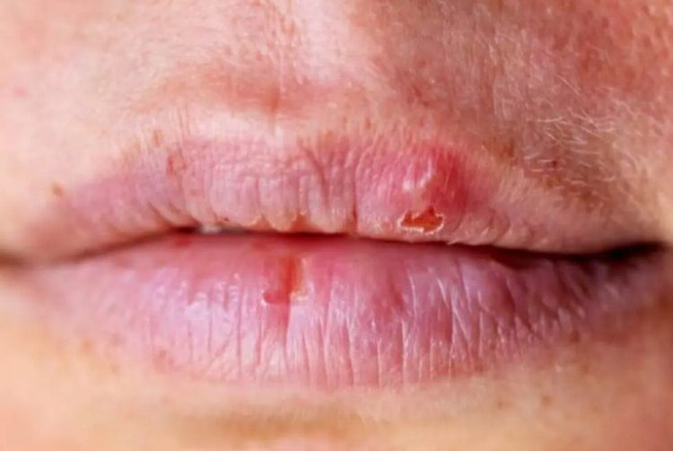 Feridas na boca podem indicar níveis descontrolados de açúcar no sangue – Foto: Freepik/ND