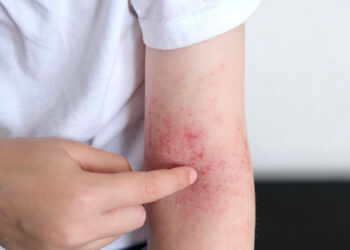 Dermatite atópica é uma doença genética, crônica e não contagiosa, que causa coceira intensa e pele seca, afetando áreas como cotovelos, joelhos e pescoço. Imagem: Reprodução