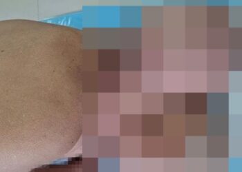 Cirurgiões removeram tumor gigantesco de paciente russo — Foto: Reprodução/X