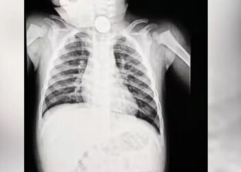 Exame revelou bateria do brinquedo lousa mágica no esôfago do bebê. Foto: Reprodução/@panelinhadare