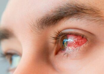 Casos recentes chamam atenção para a ceratite por Acanthamoeba. Imagem: Reprodução