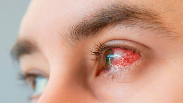 Casos recentes chamam atenção para a ceratite por Acanthamoeba. Imagem: Reprodução