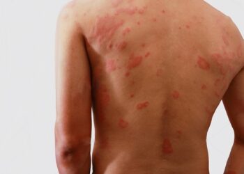 Pessoa infectada com hanseníase. Imagem: Reprodução