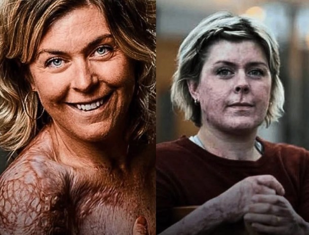 Emma Schols enfrentou incêndio e iniciou longa recuperação. Imagem: Reprodução