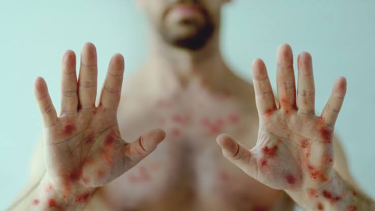 A sífilis é uma infecção sexualmente transmissível causada pela bactéria Treponema pallidum. Imagem: Reprodução