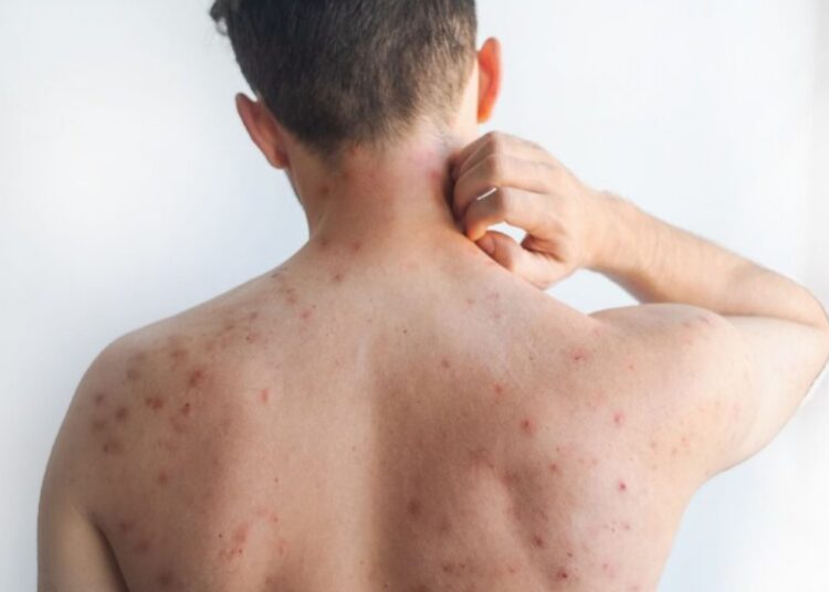 O sarampo é uma doença viral infecciosa grave e altamente contagiosa. Imagem: Reprodução